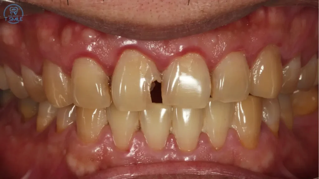 răng sâu bị vỡ có trám được không