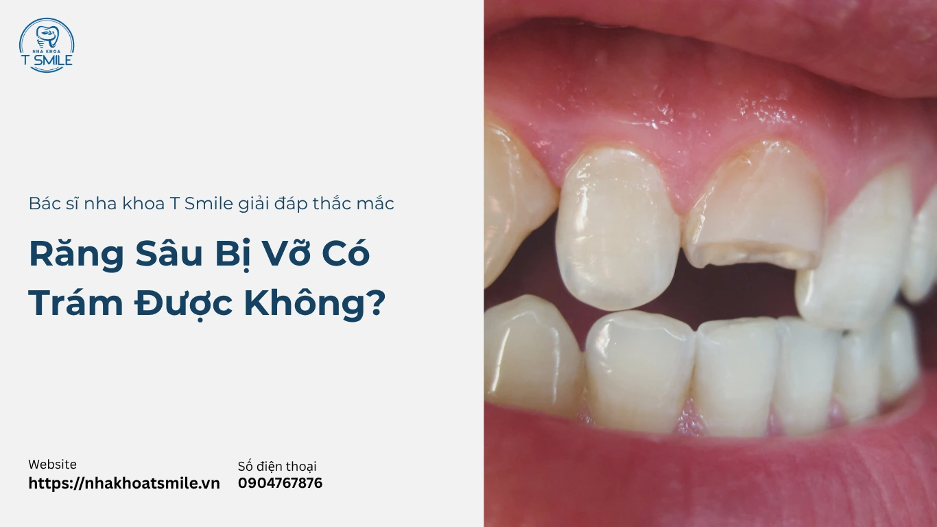 răng sâu bị vỡ có trám được không