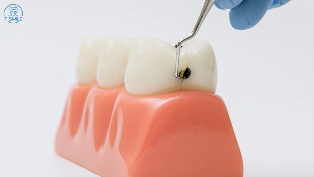 Sâu Răng Có Tự Khỏi Không