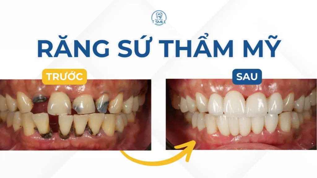 răng sứ kim loại có tốt không
