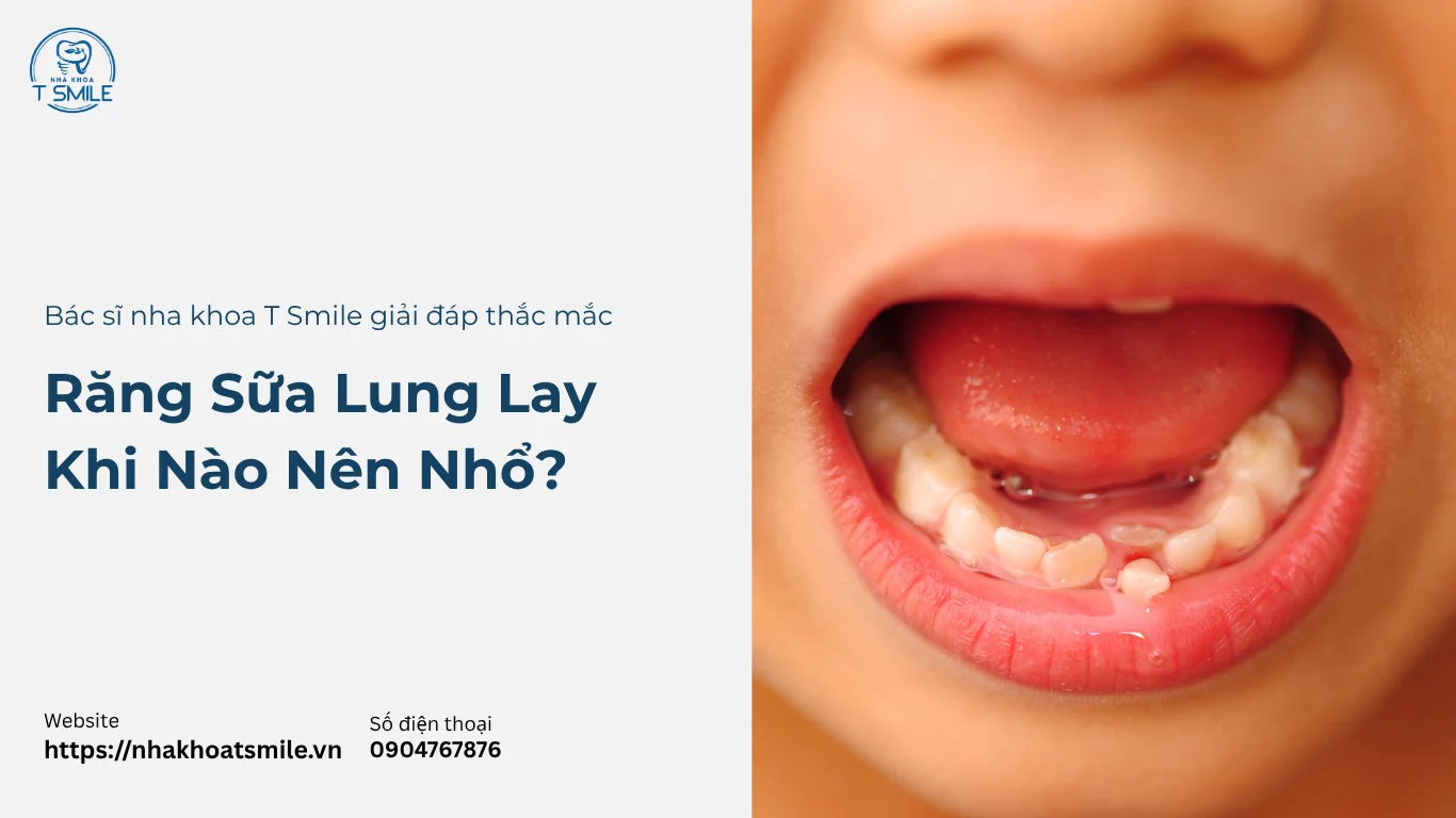 răng sữa lung lay bao lâu thì nhổ