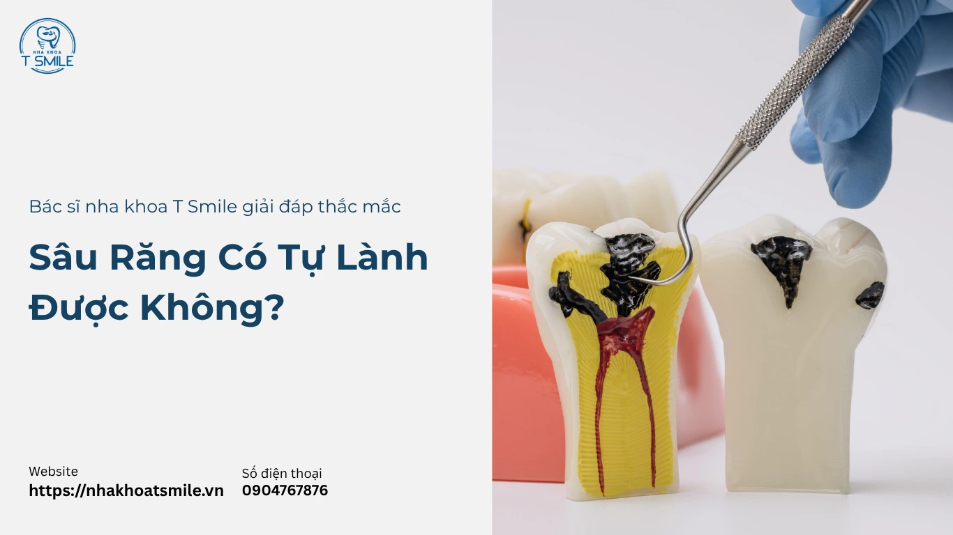 sâu răng có tự lành được không