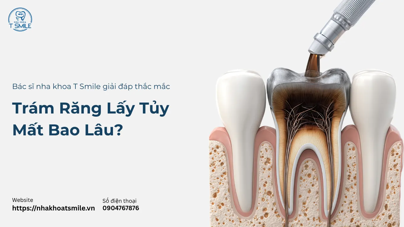 trám răng lấy tuỷ mất bao lâu