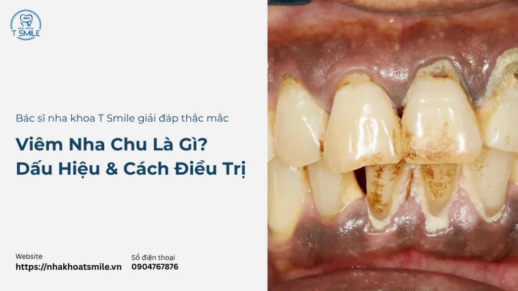 viêm nha chu là gì
