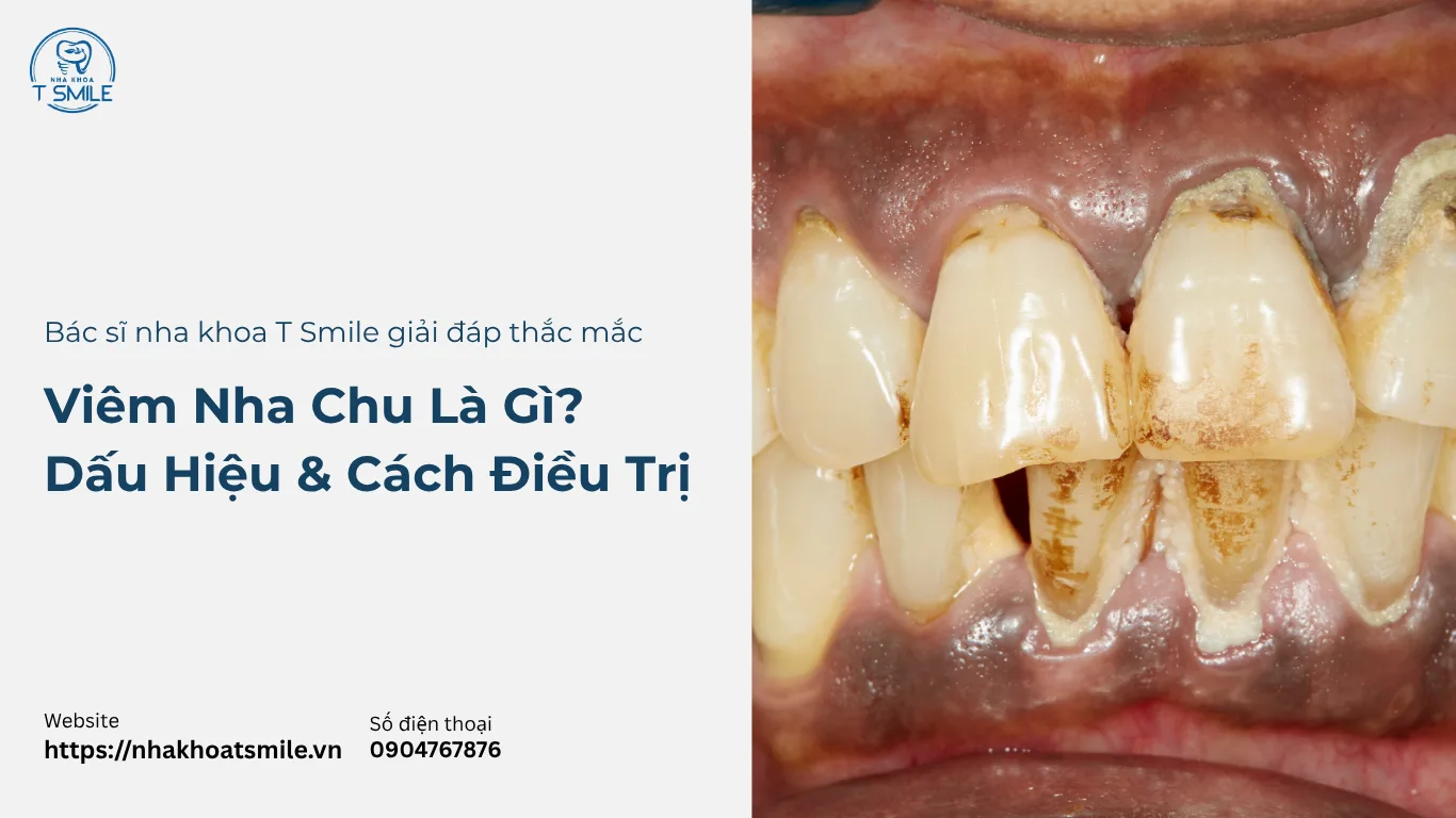 viêm nha chu là gì