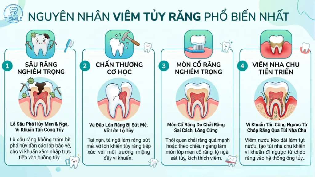 viêm tuỷ răng là gì