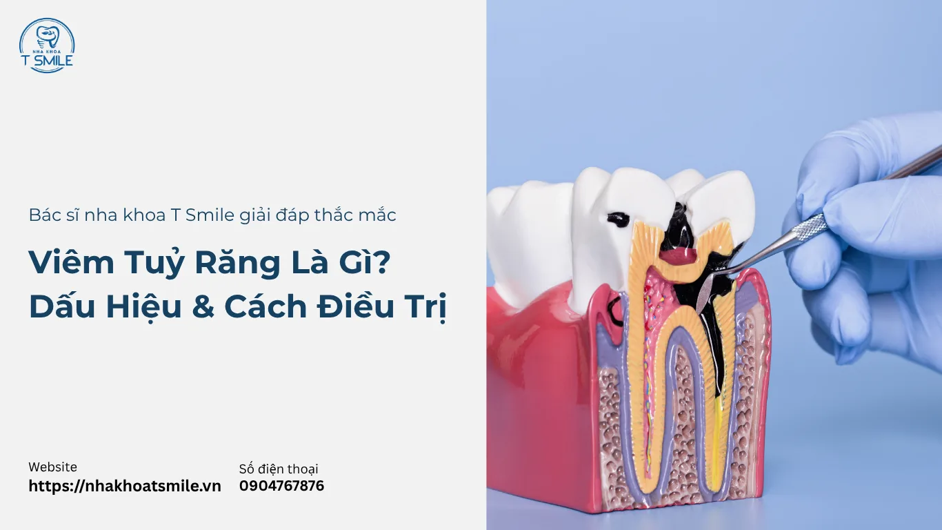 viêm tuỷ răng là gì