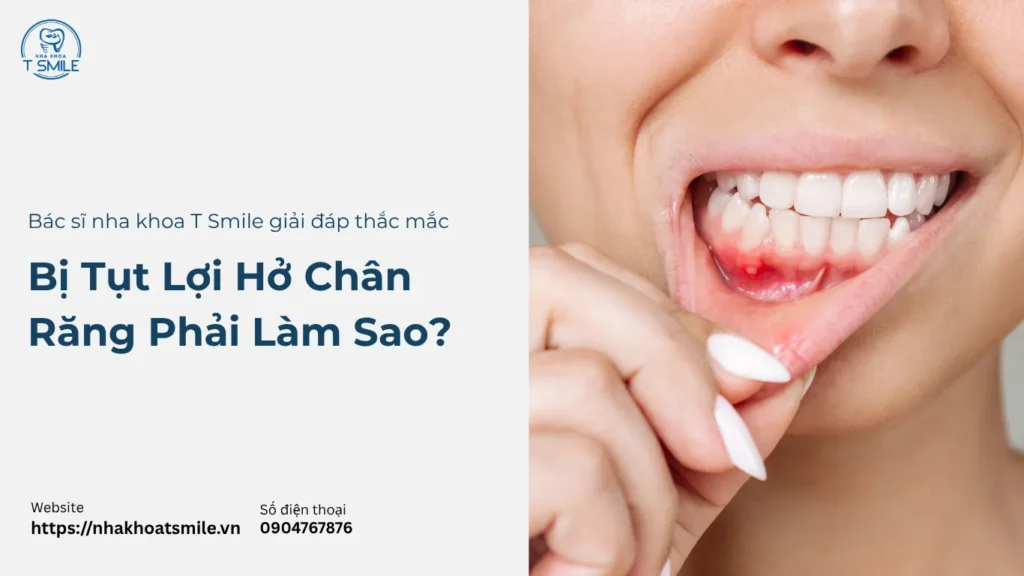 bị tụt lợi hở chân răng phải làm sao