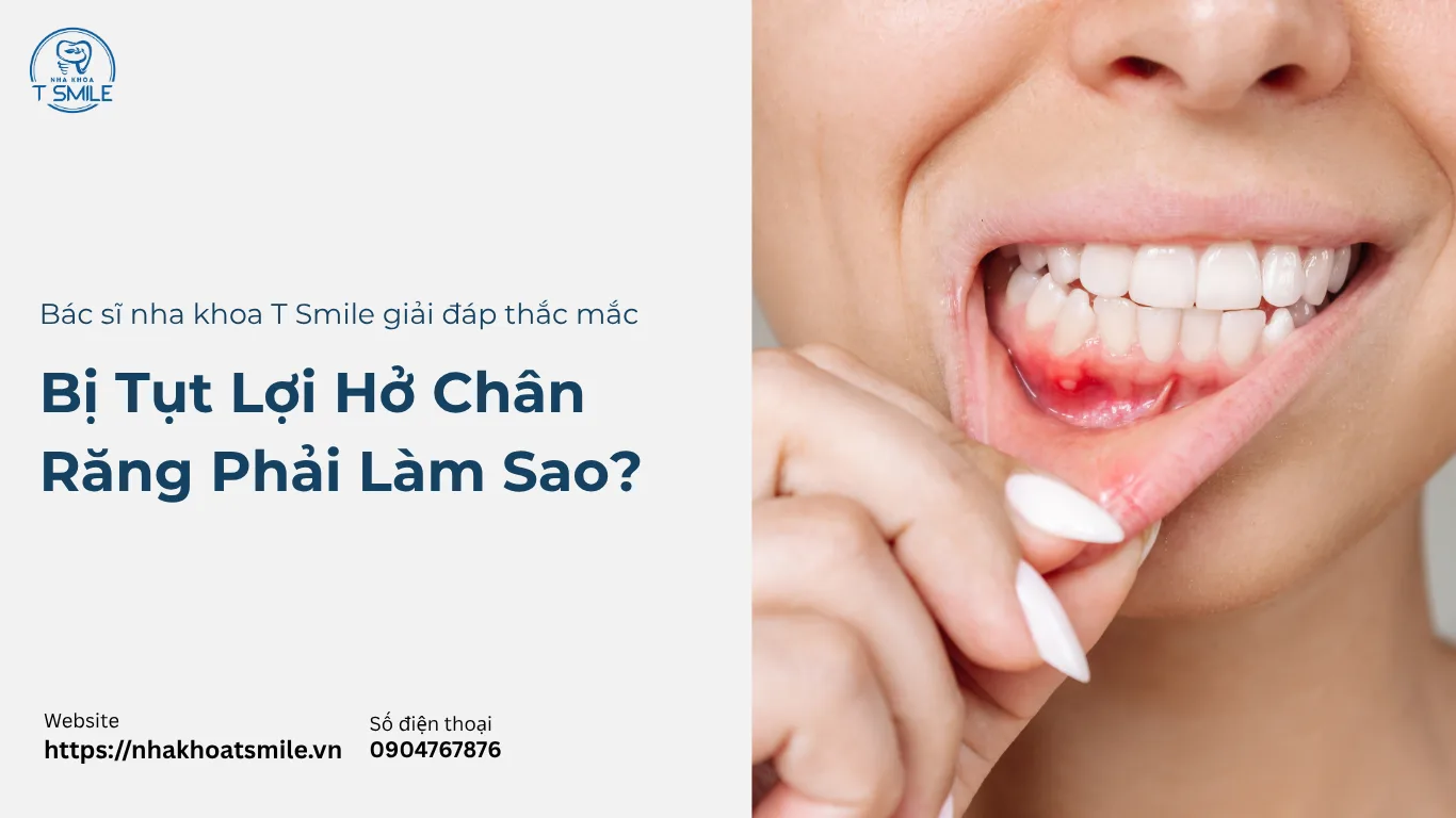 bị tụt lợi hở chân răng phải làm sao