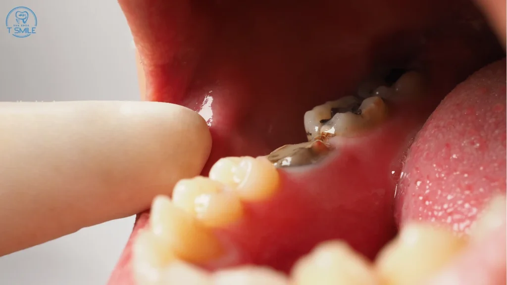 cách giảm đau răng khôn bị sâu