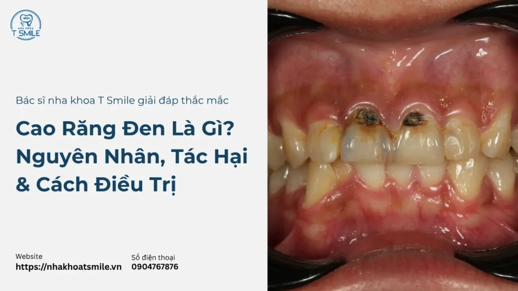 cao răng đen là gì