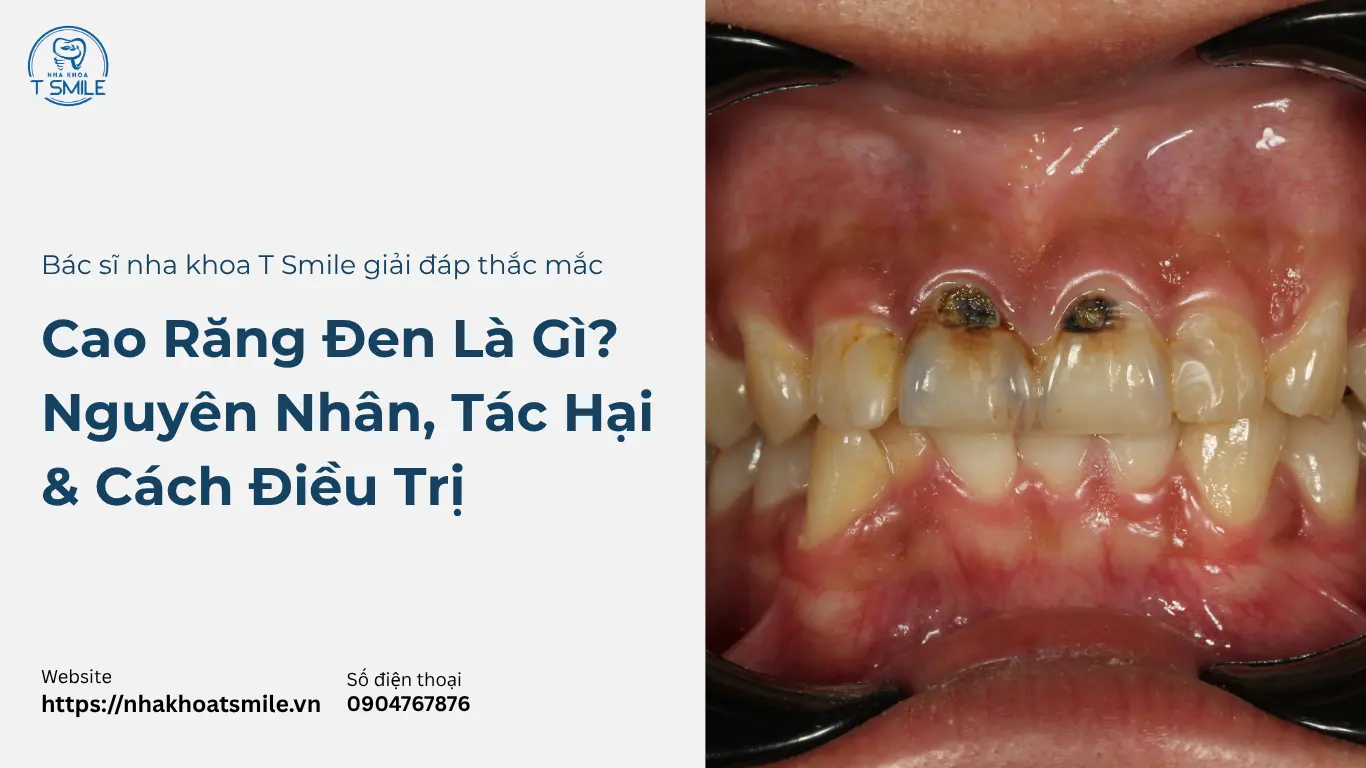 cao răng đen là gì