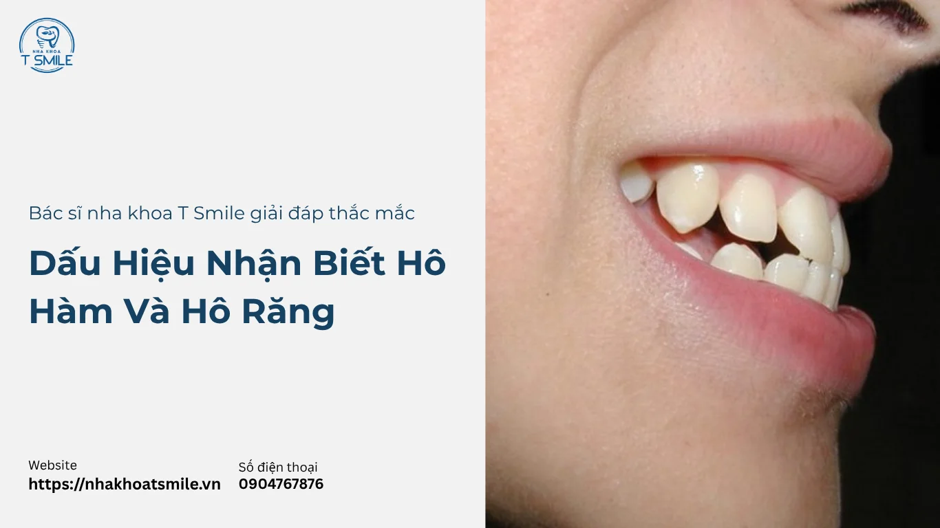 dấu hiệu nhận biết hô hàm và hô răng