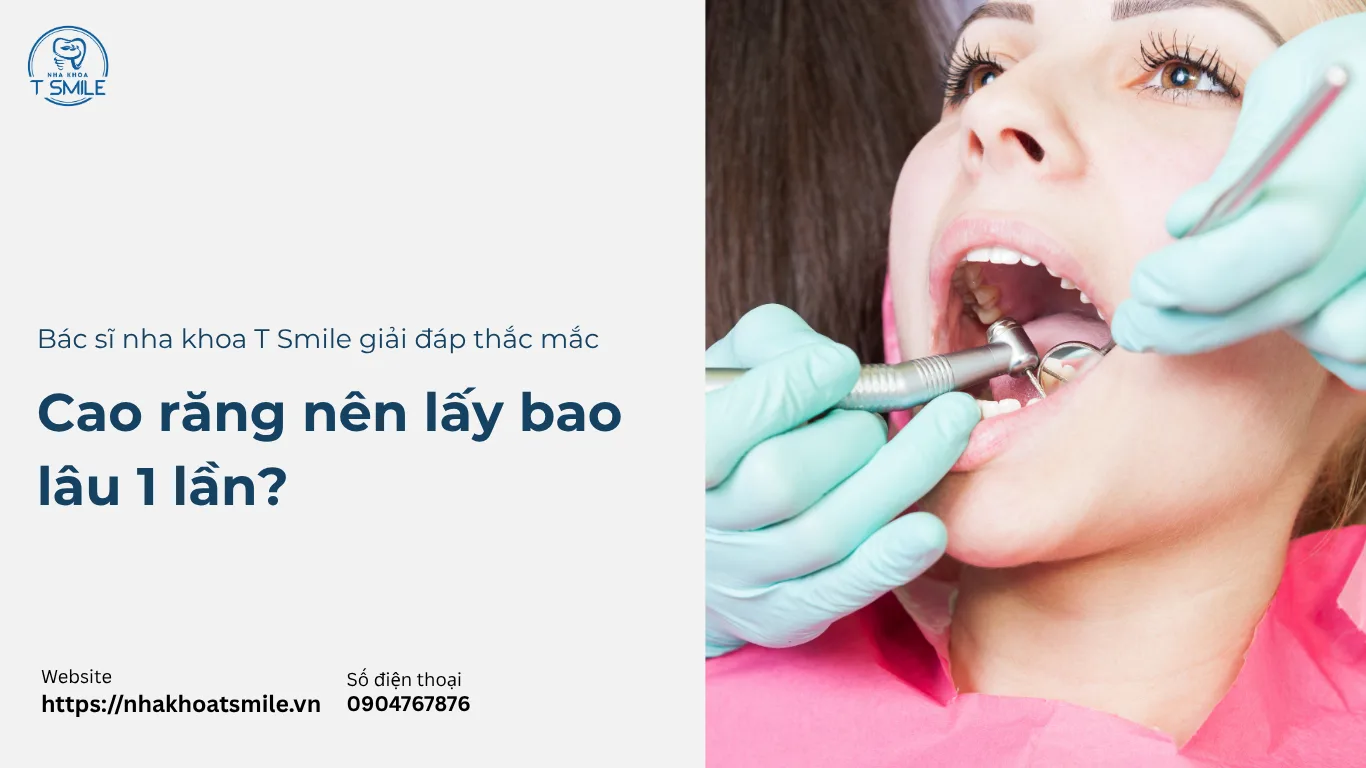 cao răng nên lấy bao lâu 1 lần