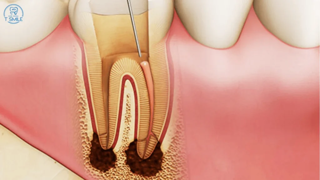 điều trị tủy răng chưa đóng chóp