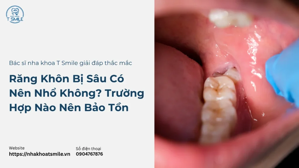 răng khôn bị sâu có nên nhổ không​
