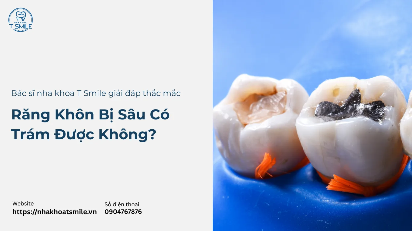 Răng khôn bị sâu có trám được không