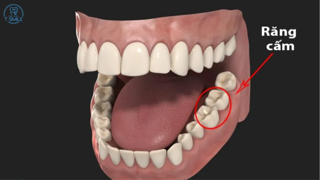  răng khôn và răng cấm giống nhau không
