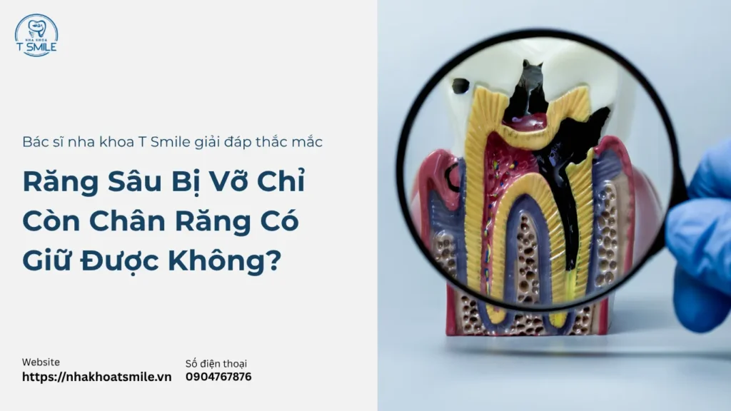 răng sâu bị vỡ chỉ còn chân răng