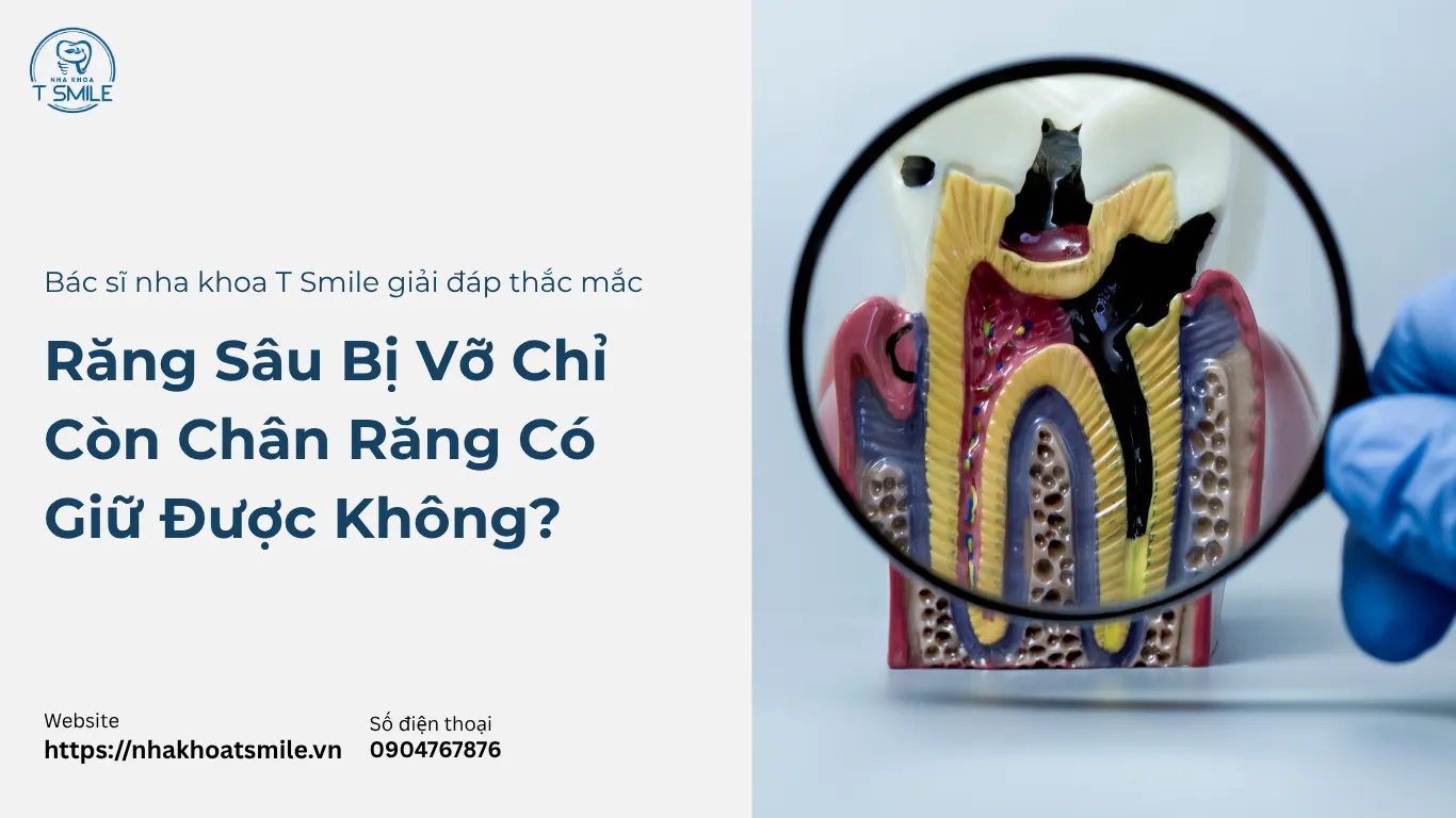 răng sâu bị vỡ chỉ còn chân răng