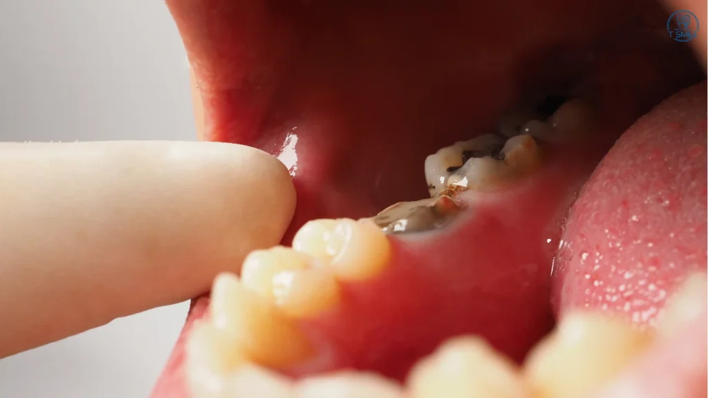 răng sâu bị chảy máu