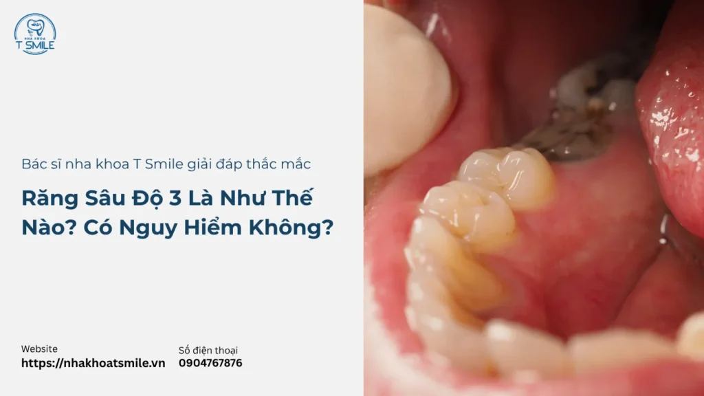 răng sâu độ 3 là như thế nào