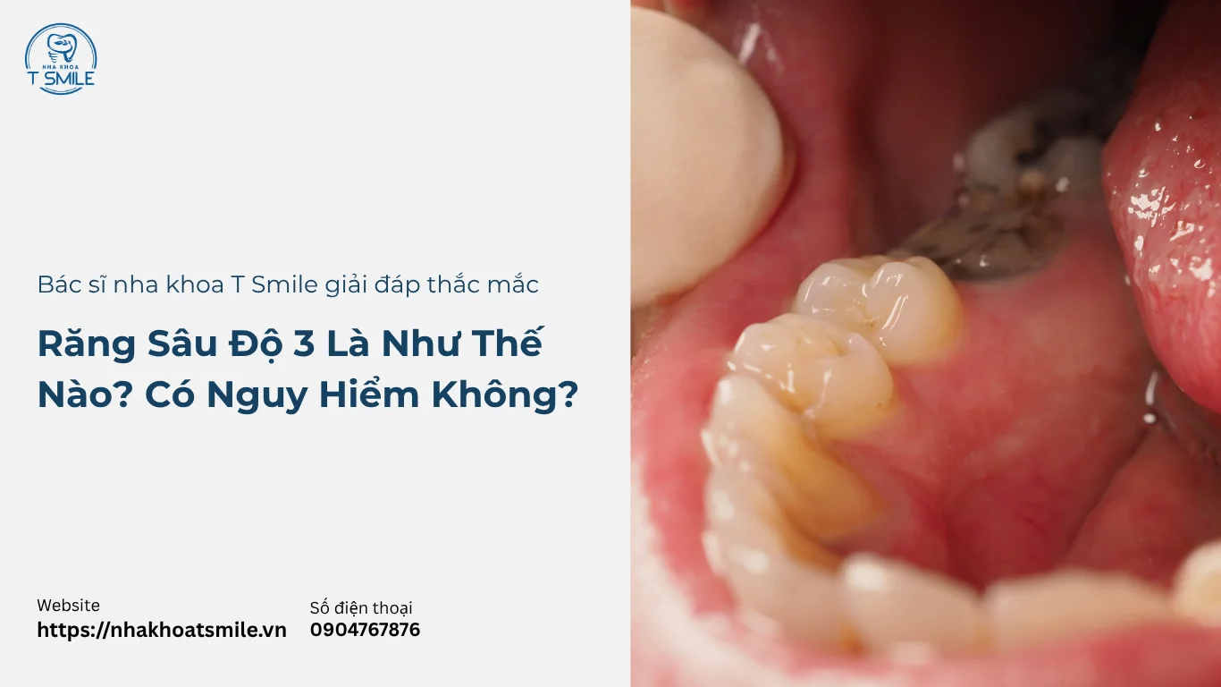 răng sâu độ 3 là như thế nào