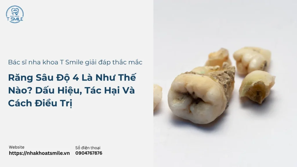 răng sâu độ 4