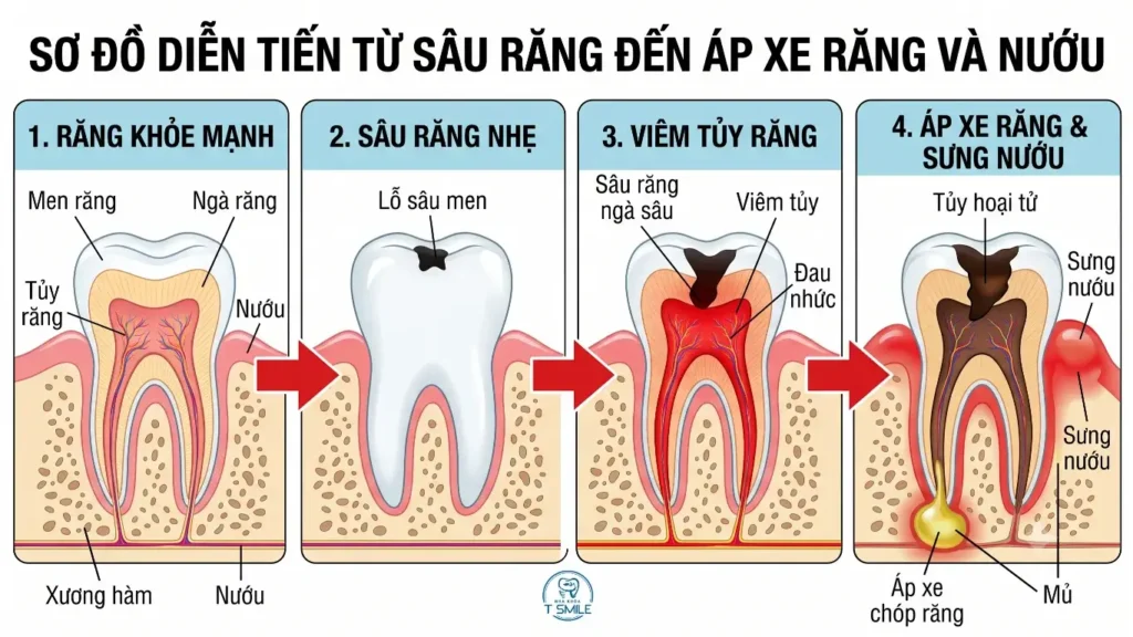 răng sâu sưng nướu