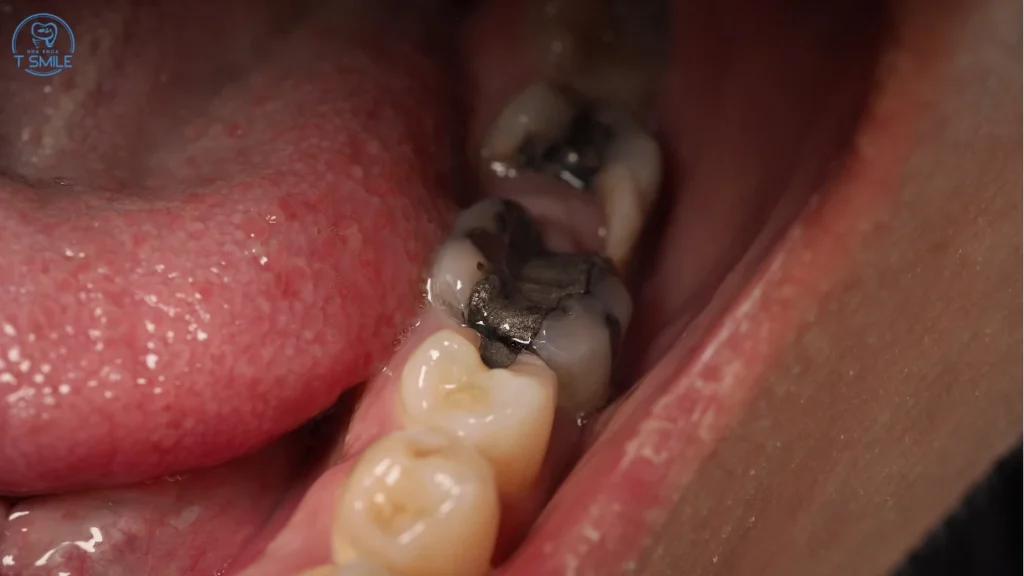 sâu răng có niềng được không