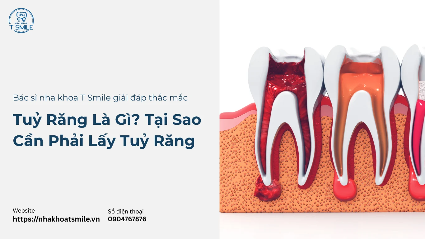 tại sao phải lấy tuỷ răng