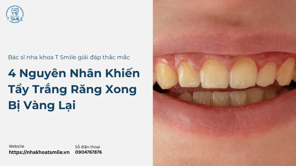 tẩy trắng răng xong bị vàng lại