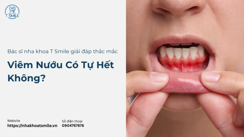 viêm nướu có tự hết không