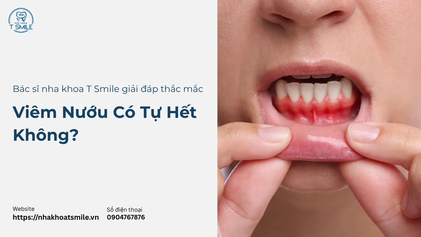 viêm nướu có tự hết không