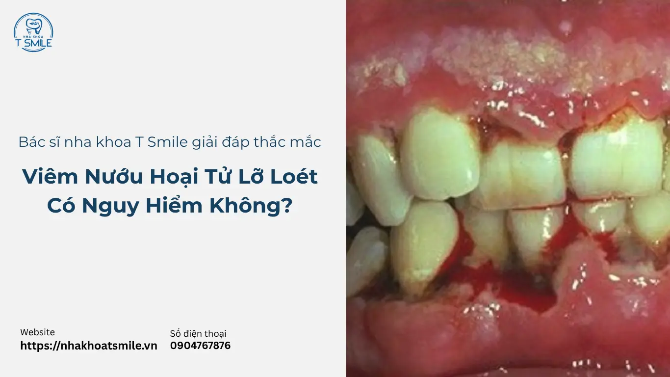 viêm nướu hoại tử