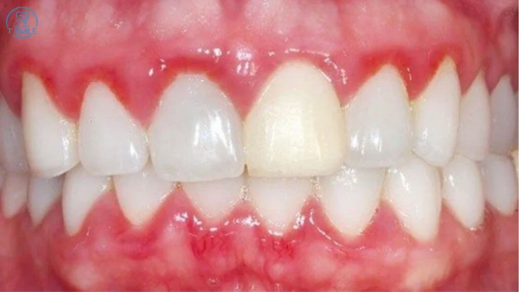viêm nướu triển dưỡng