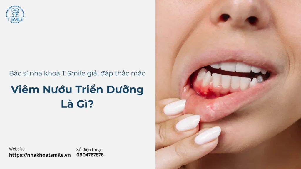 viêm nướu triển dưỡng