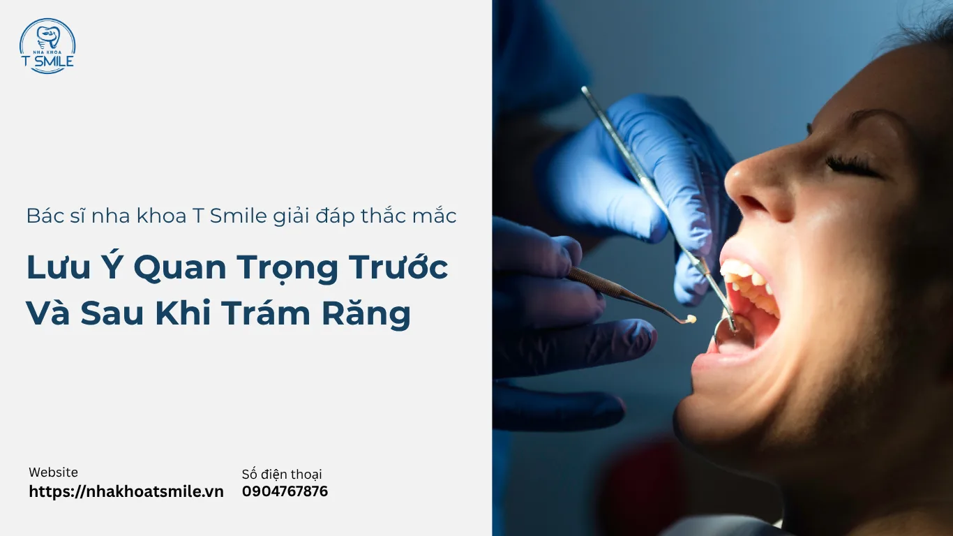lưu ý khi trám răng