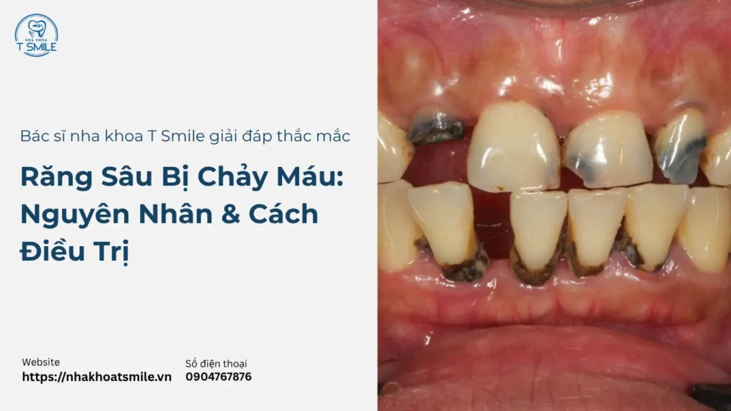 răng sâu chảy máu